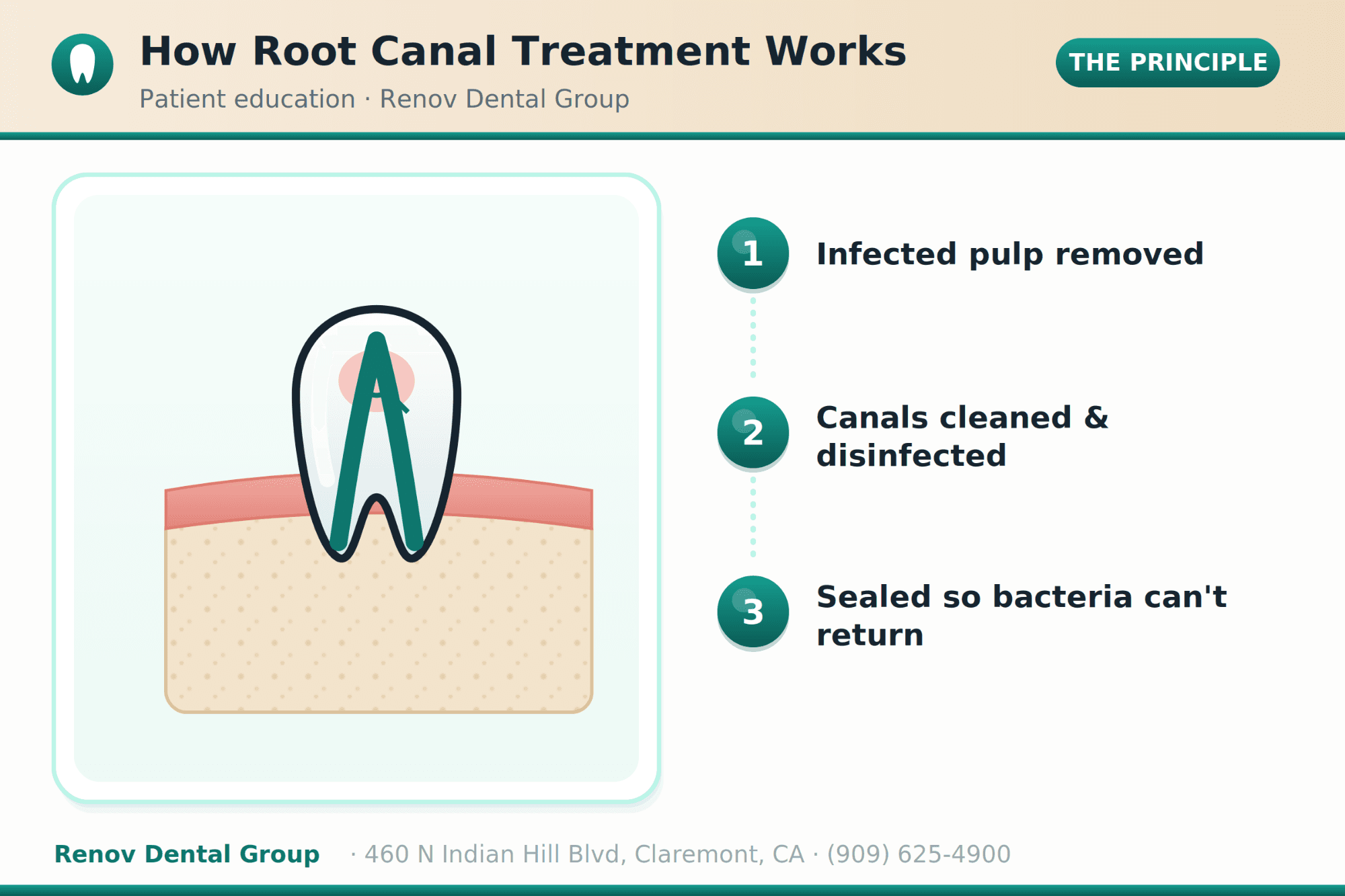 Root Canal Treatment in San Dimas