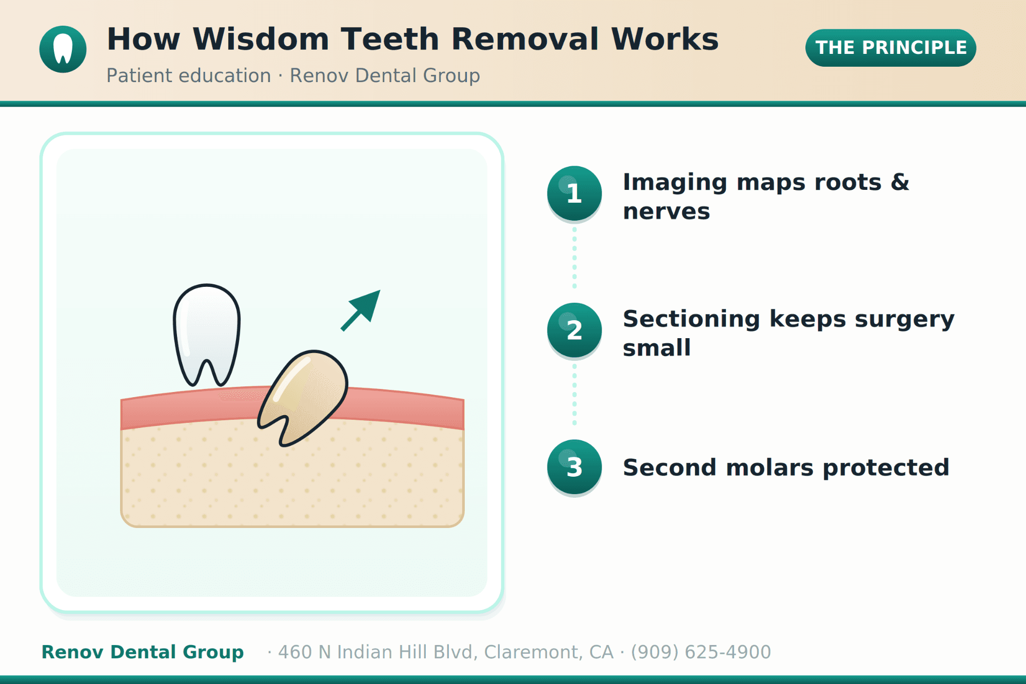 Wisdom Teeth Removal in San Dimas
